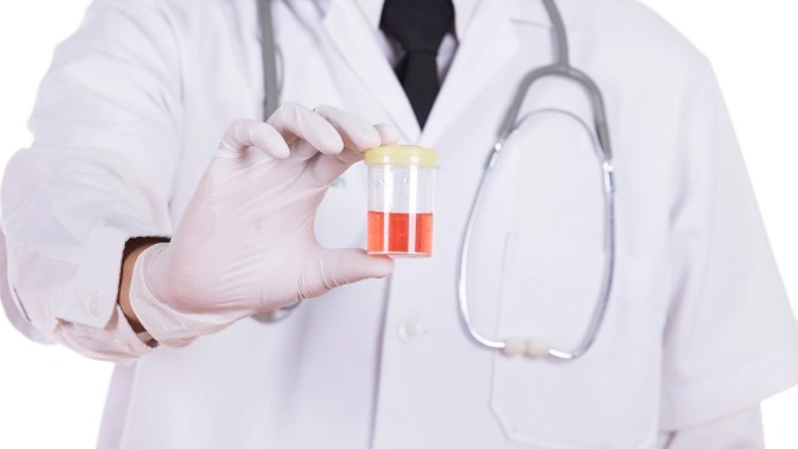 Cauzele comune pentru urina cu sânge la femei. Ce boli ascunde această problemă medicală?