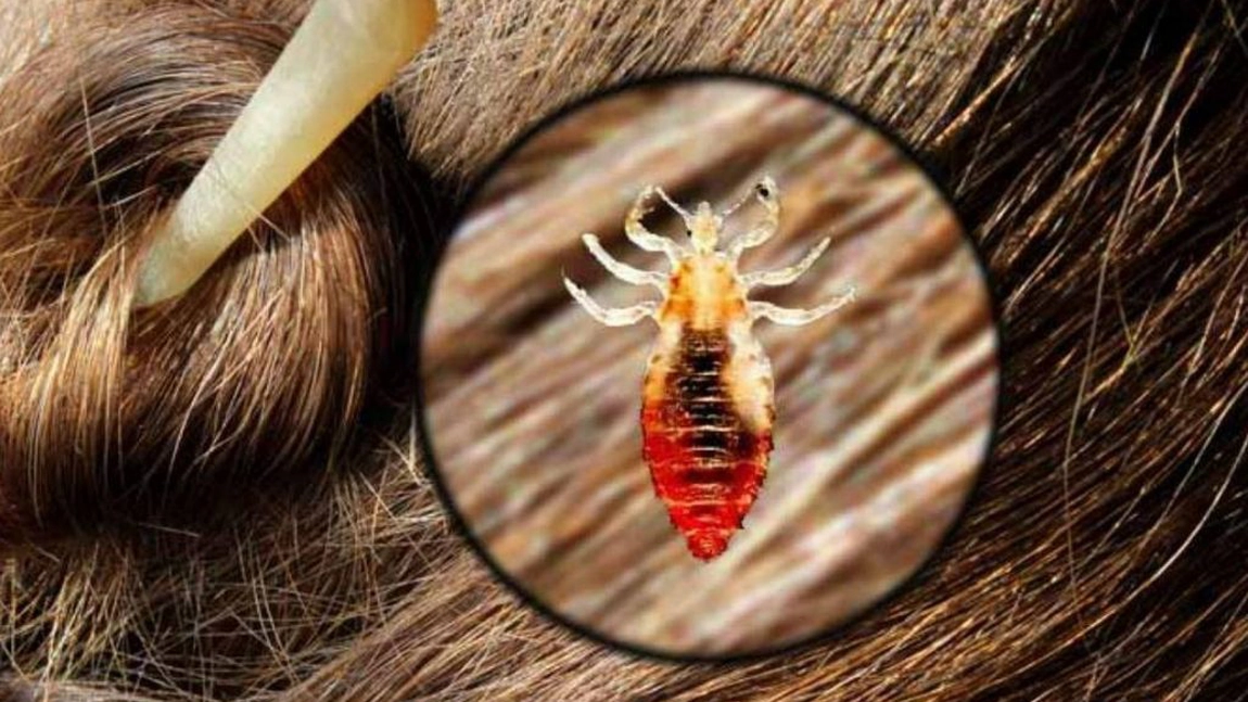 Păduchii de cap mor cu oțet? Ce trebuie să știi despre acest remediu natural