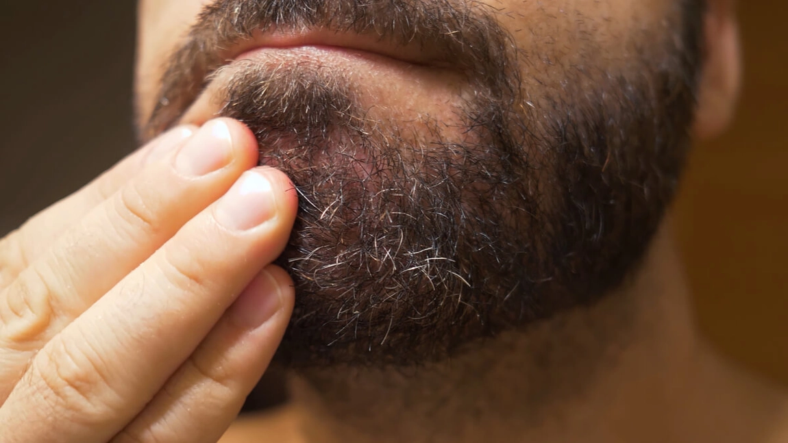 Dermatita seboreică la nivelul feței. Remedii naturiste pentru tratarea afecțiunii