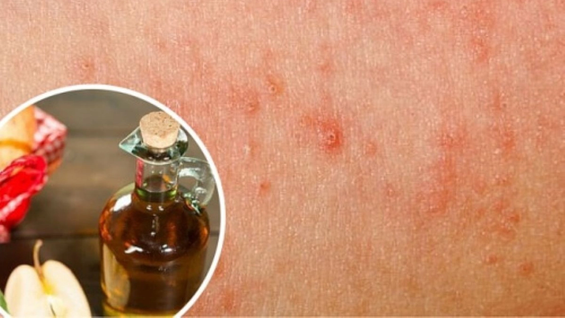Cu această cremă naturală poți vindeca acasă ciuperca de piele! Iată cum pot fi ținute sub control aceste infecții fungice