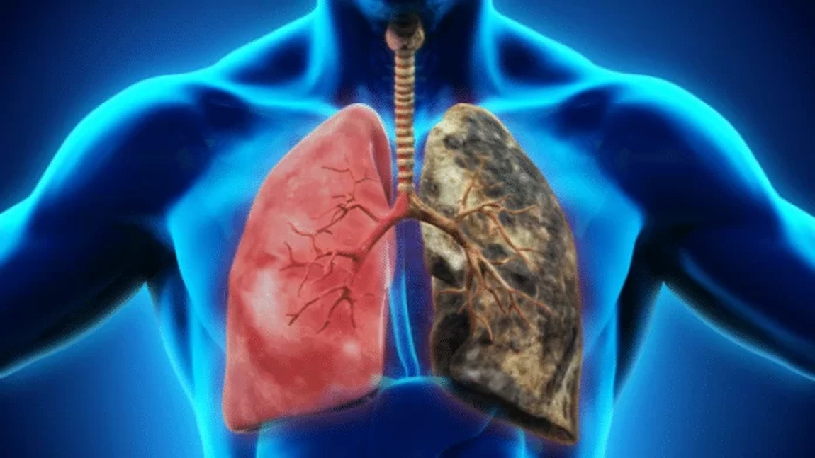 Cancerul pulmonar a devenit principala cauză de mortalitate în lume! Cinci pași de urmat pentru a reduce riscul