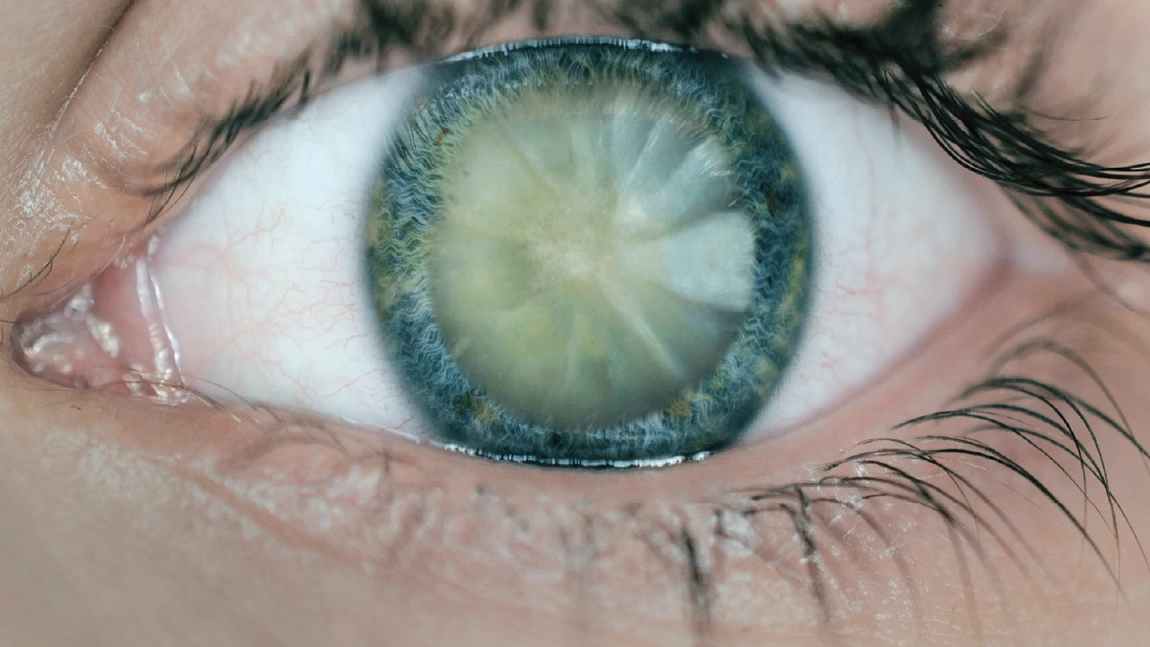Cataractă, simptome și cauze. Ce poți face pentru a îți îmbunătăți vederea