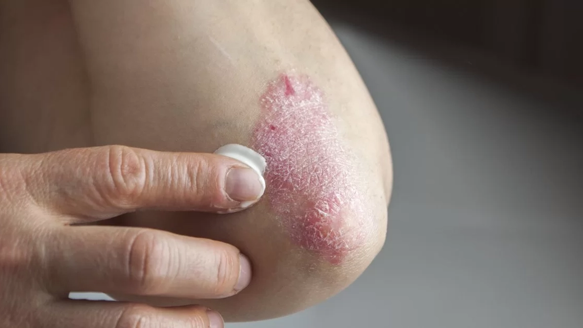 Cea mai bună cremă pentru psoriazis. Cum poți accelera procesul de recuperare