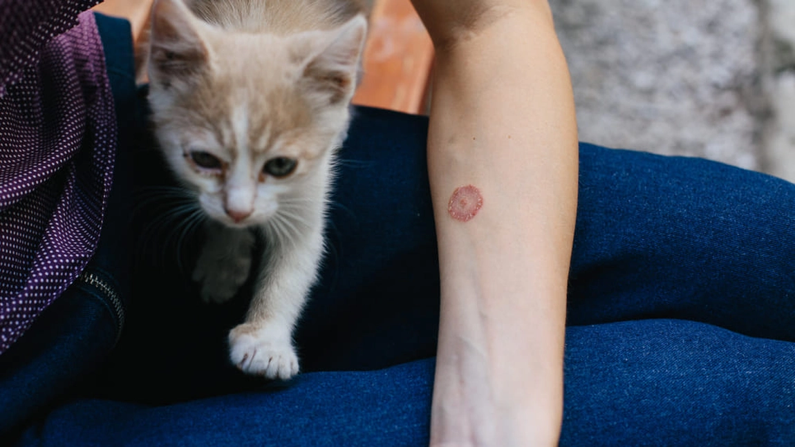 Eczema pecingine, poze. Tot ce trebuie să știi despre această afecțiune a pielii
