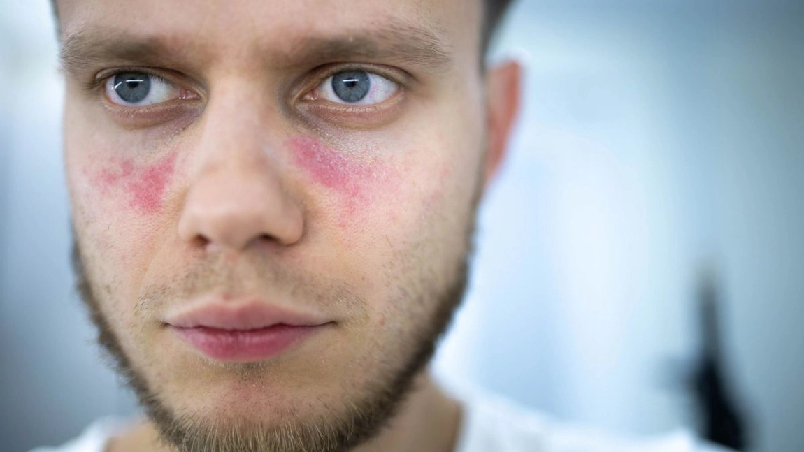 Lupus eritematos sau „boala cu o mie de fețe”. Cum se manifestă afecțiunea autoimună