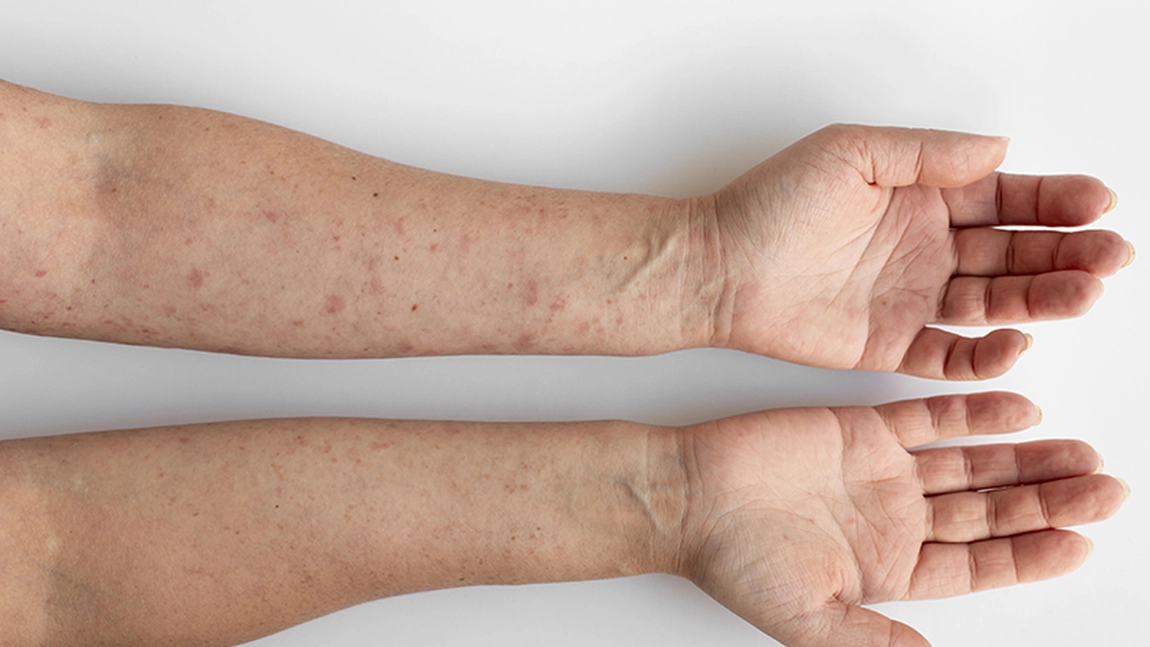 Cum se manifestă scarlatina la adulți, o boală a copilăriei ce este extrem de contagioasă