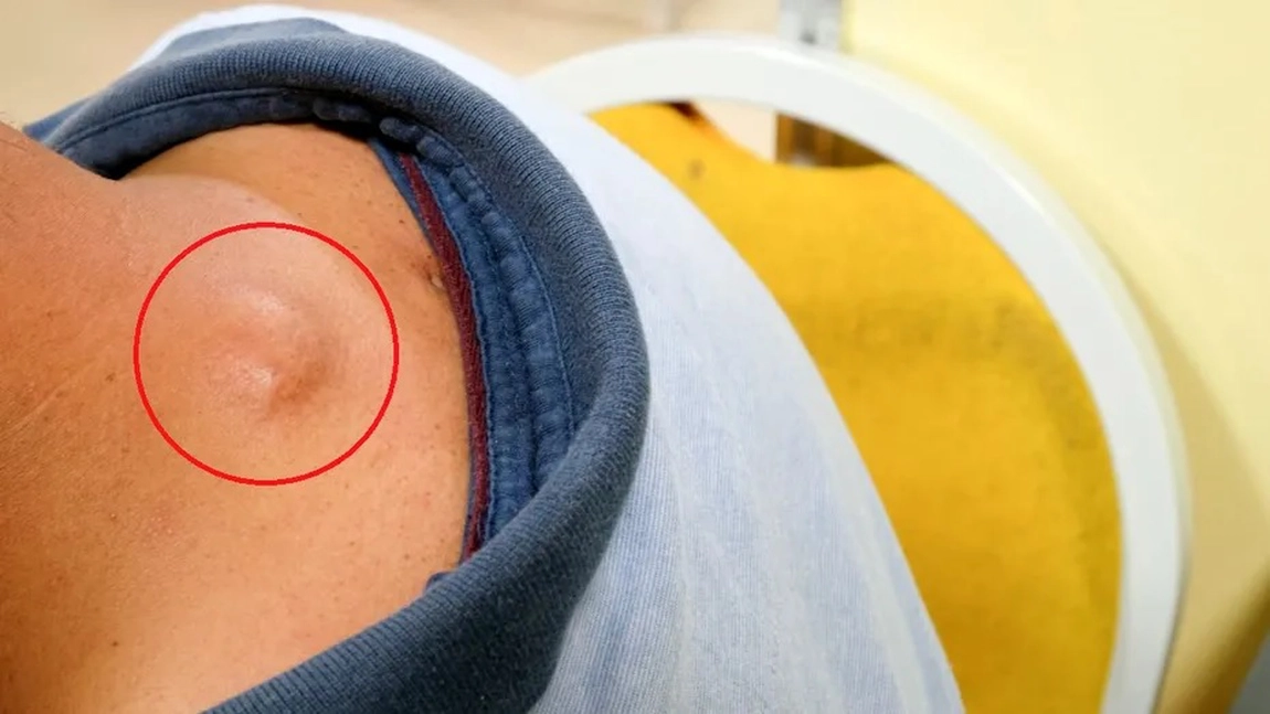 Există plante care trag lipomul? Află dacă poți scăpa de el fără operație
