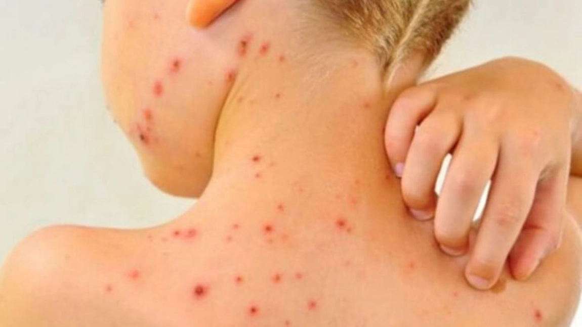 Cât durează pojarul? Simptome și prevenire