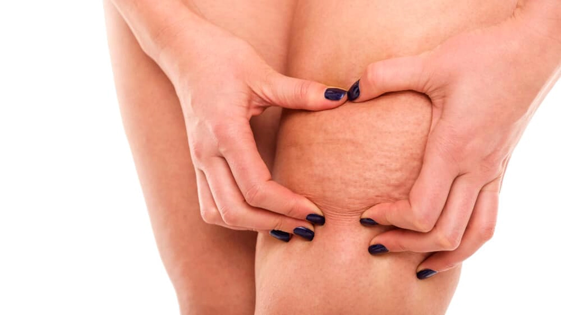 Cum să scapi de celulita de pe picioare. Tratament și remedii naturiste pentru pielea cu aspect de coajă de portocală