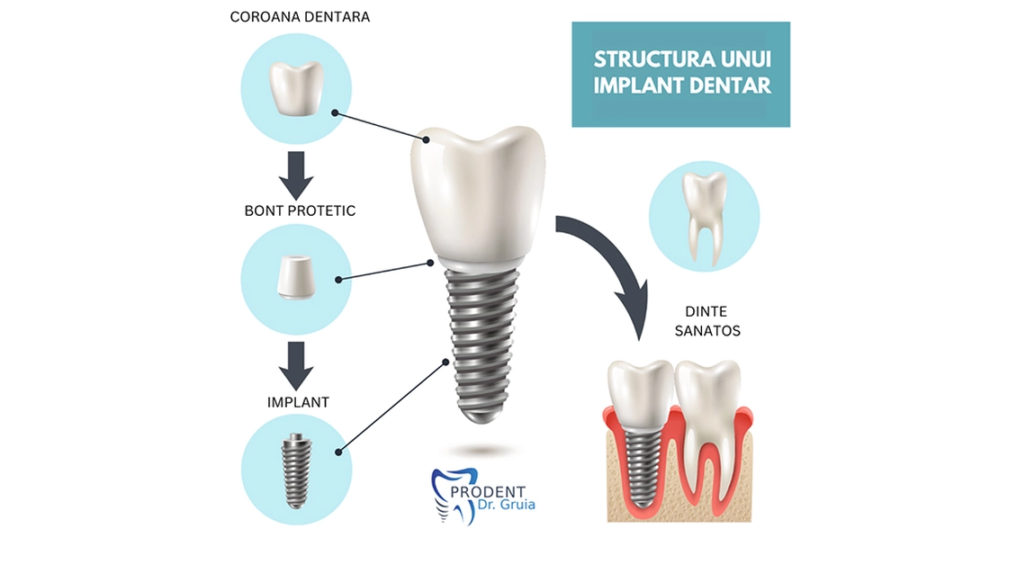 Ai nevoie de un implant dentar? Cinci semne care îți arată că e momentul să acționezi