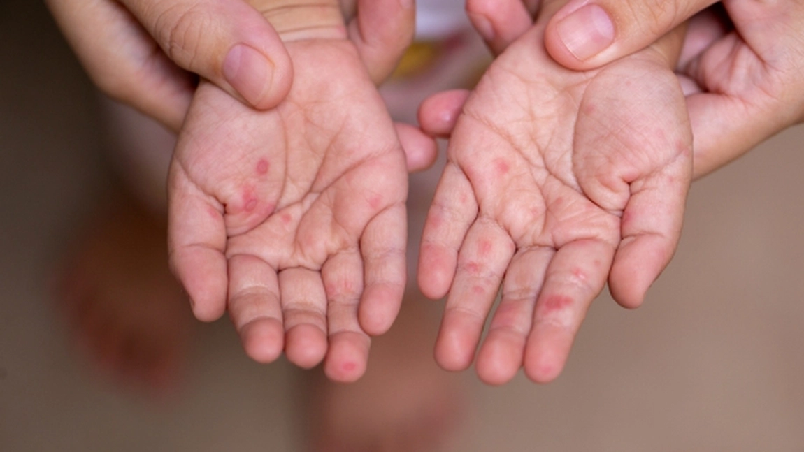 Nouă alertă sanitară: Un copil nevaccinat, victima rujeolei. Epidemia se extinde rapid