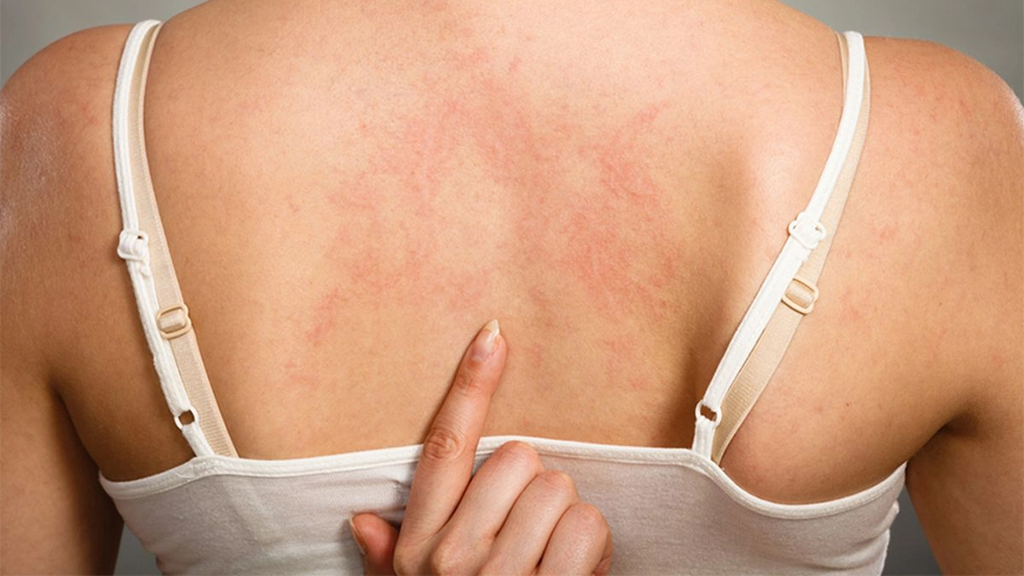 Cât durează o alergie de piele? Cum le tratezi