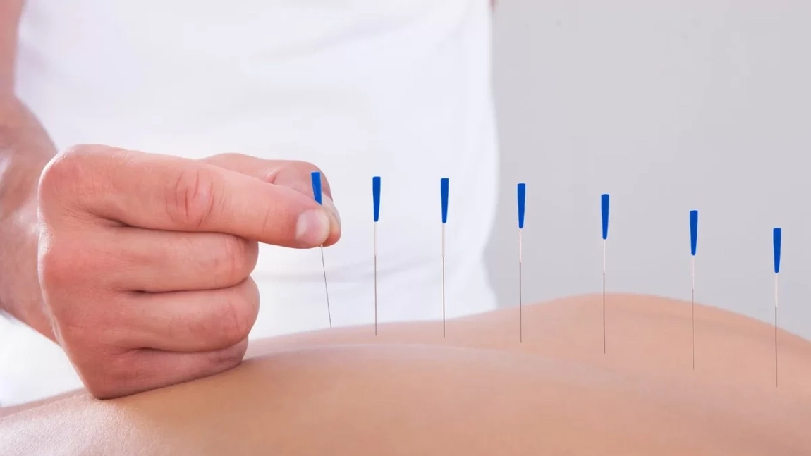 Ce boli tratează acupunctura. Cum funcționează și când este recomandată procedura