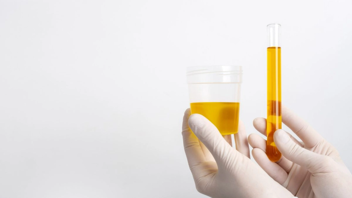 Ce este urocultura și care este importanța testelor de urină în diagnosticarea infecțiilor