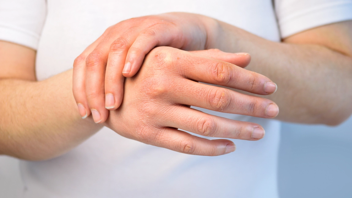 Ce poți face dacă te confrunți cu descuamarea pielii. Soluții eficiente împotriva exfolierii