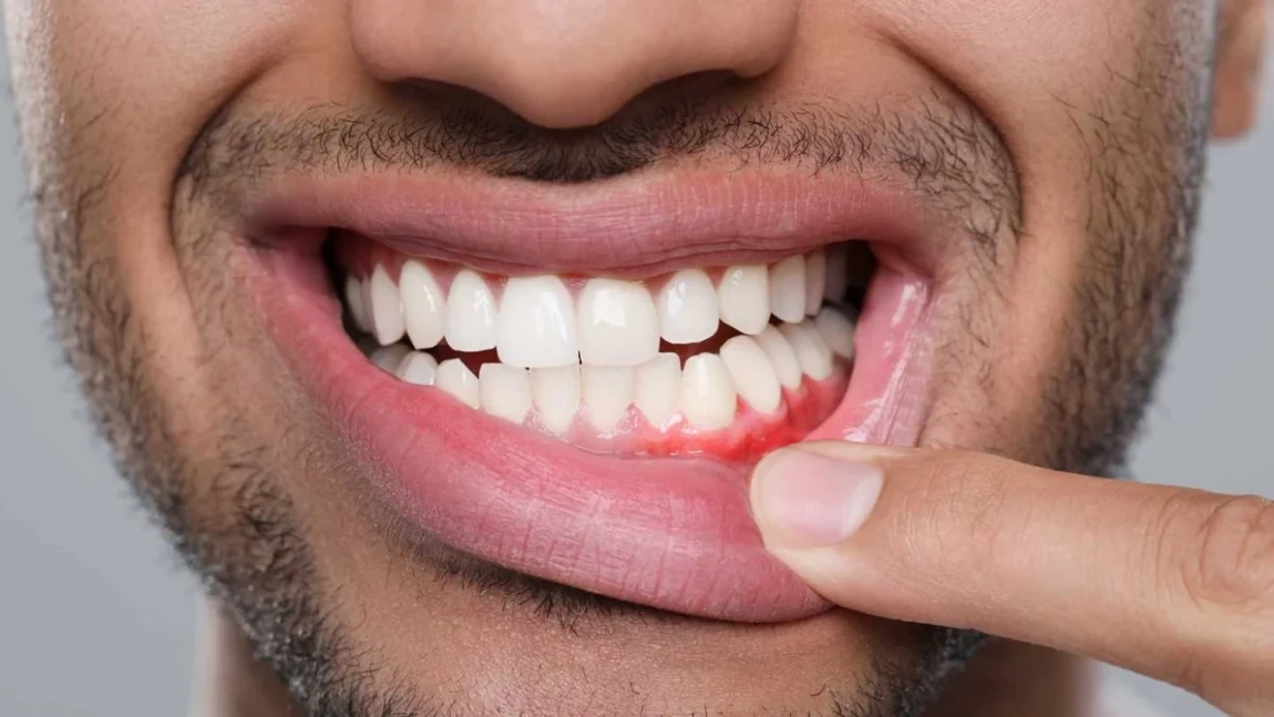 Gel pentru gingii. Care sunt cele mai eficiente soluții pentru tratarea inflamației gingivale