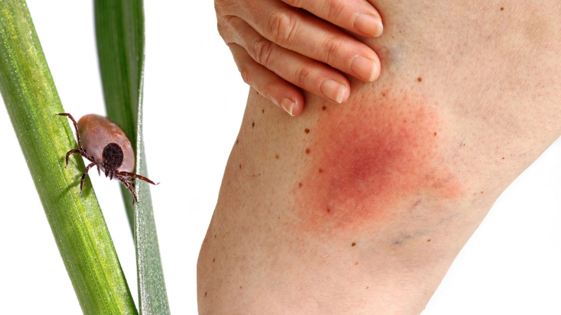 Când este periculoasă mușcătura de căpușă? Iată ce complicații pot apărea și ce ai de făcut!