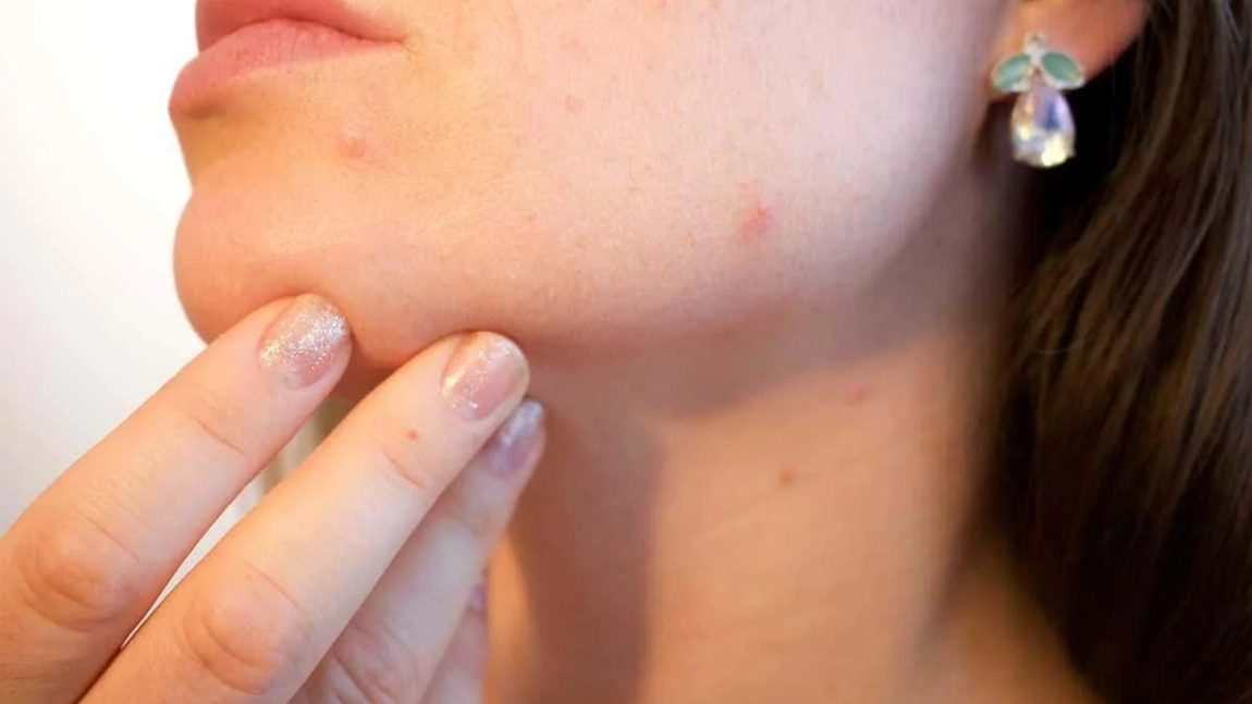 Poți face varicelă de 2 ori? Tot ce trebuie să știi despre riscul de reinfecție
