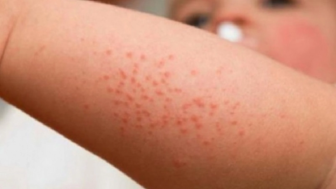 Rujeola revine în forță în SUA, dar miturile despre vaccin o sabotează. Un sfert dintre părinți au amânat imunizarea copiilor