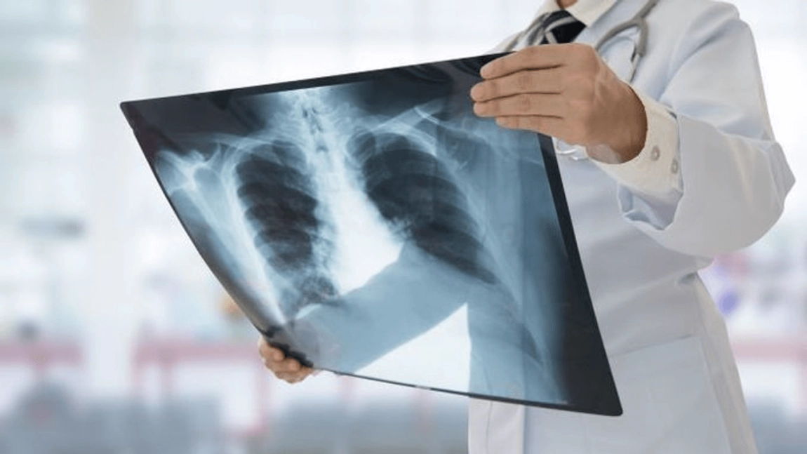 Opțiuni de tratament pentru noduli pulmonari. Care este importanța diagnosticului și a intervenției corecte