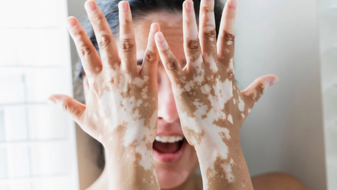 Vitiligo și cauzele sale! Iată cine este afectat și de ce!