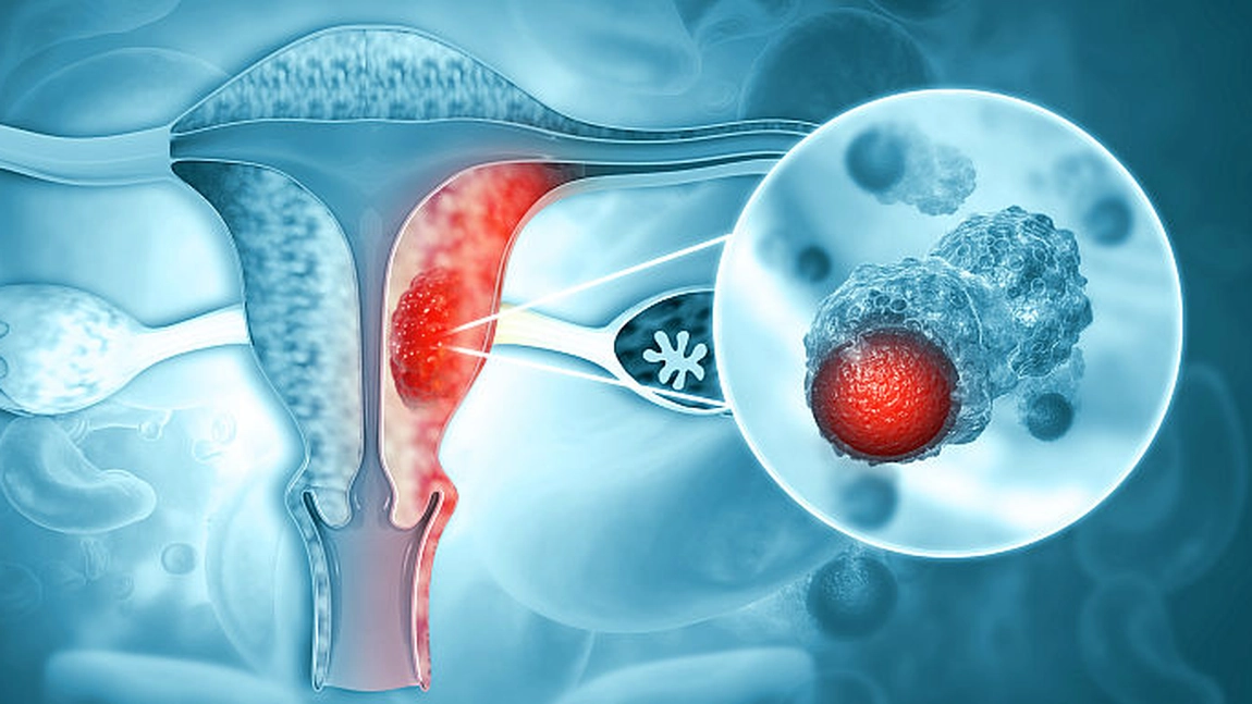 În cât timp se dezvoltă cancerul ovarian? Iată cum poți preveni această afecțiune!