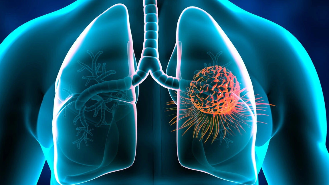 Ce este un abces pulmonar? Află ce consecințe poate avea asupra sănătății!