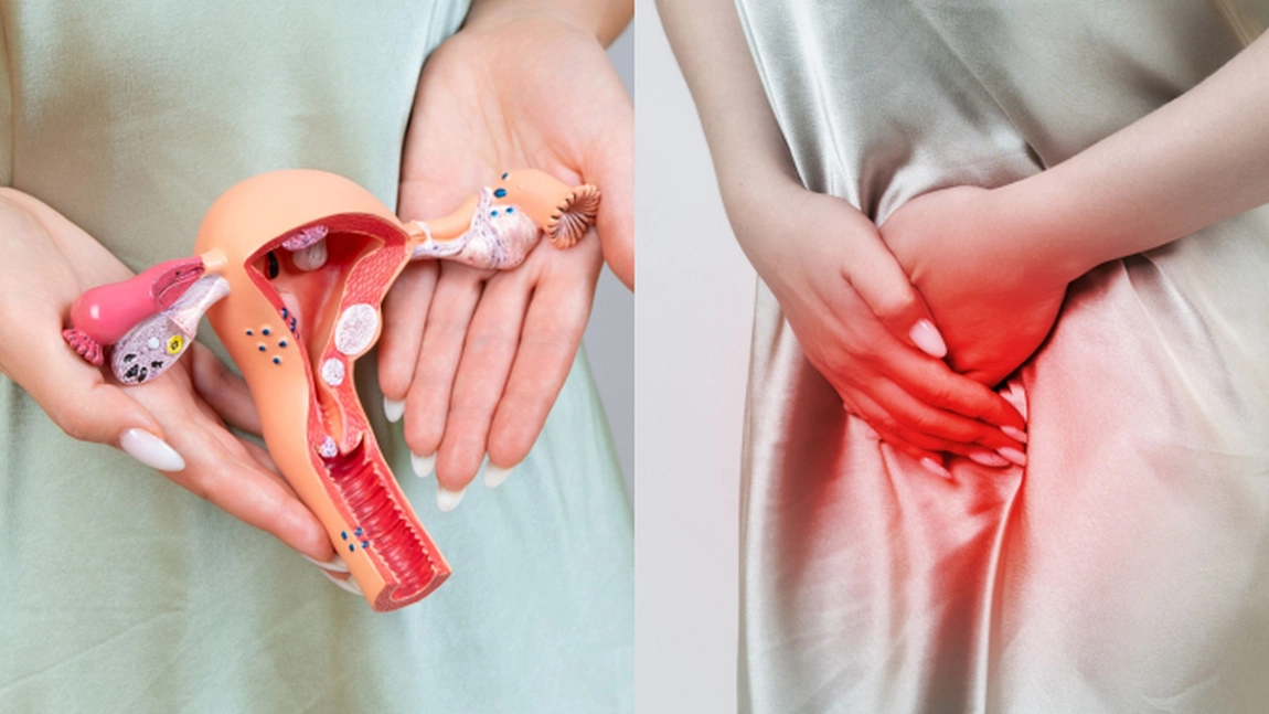 Când ai nevoie să faci o operație de endometrioză? Iată care sunt simptomele cele mai des întâlnite!