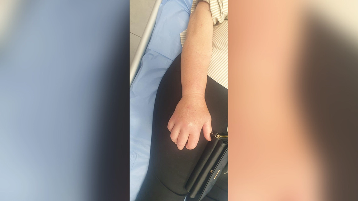 O femeie de 71 de ani a ajuns la urgențe după ce a fost mușcată de o viperă