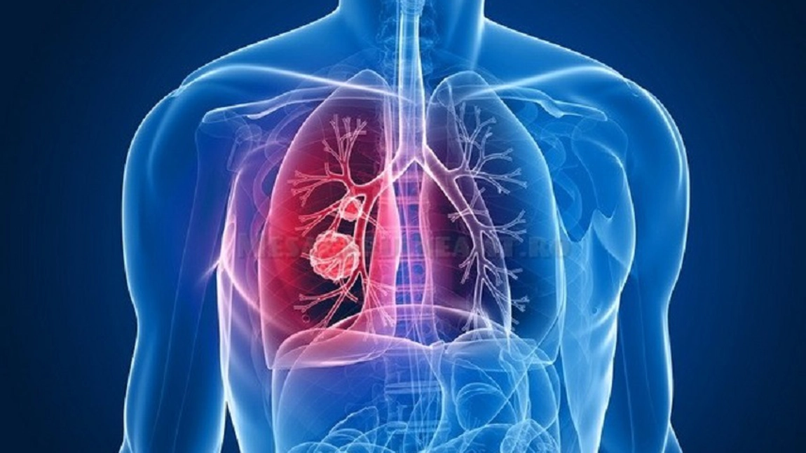  Cum să identifici rapid tuberculoza și să previi complicațiile grave ale acestei boli infecțioase.