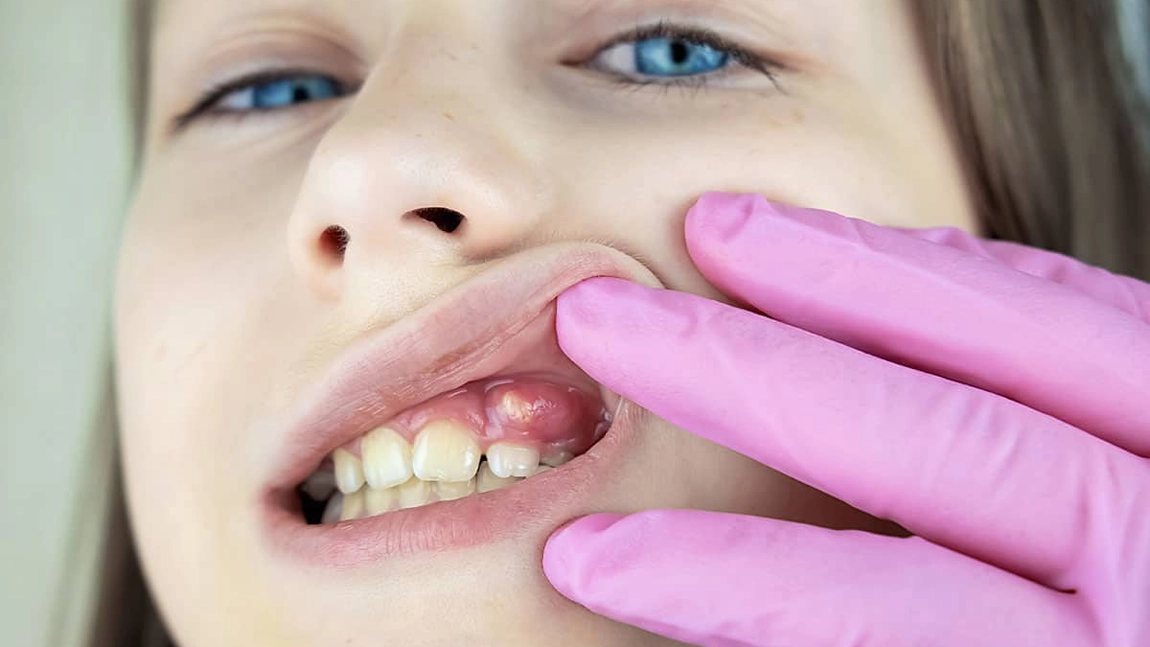 Cât de periculoasă este o infecție la măsea? Iată care sunt semnele că se răspândește!