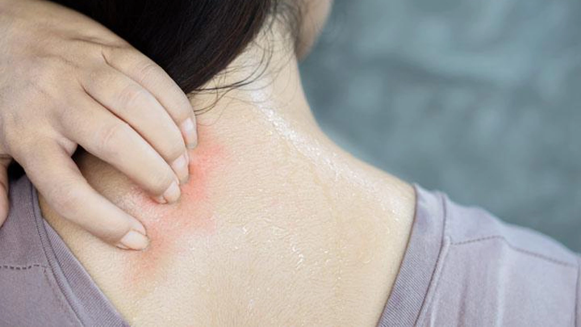 Tratamente la îndemână pentru iritațiile pielii provocate de căldură! Află când pot fi un pericol pentru sănătate!