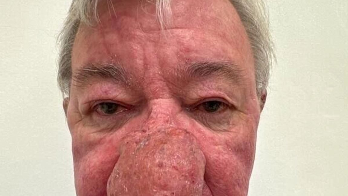 Un pensionar a fost desfigurat de rinofimă: „Nasul meu a crescut atât de mult încât nu mai puteam bea bere sau să-mi sărut soția!”