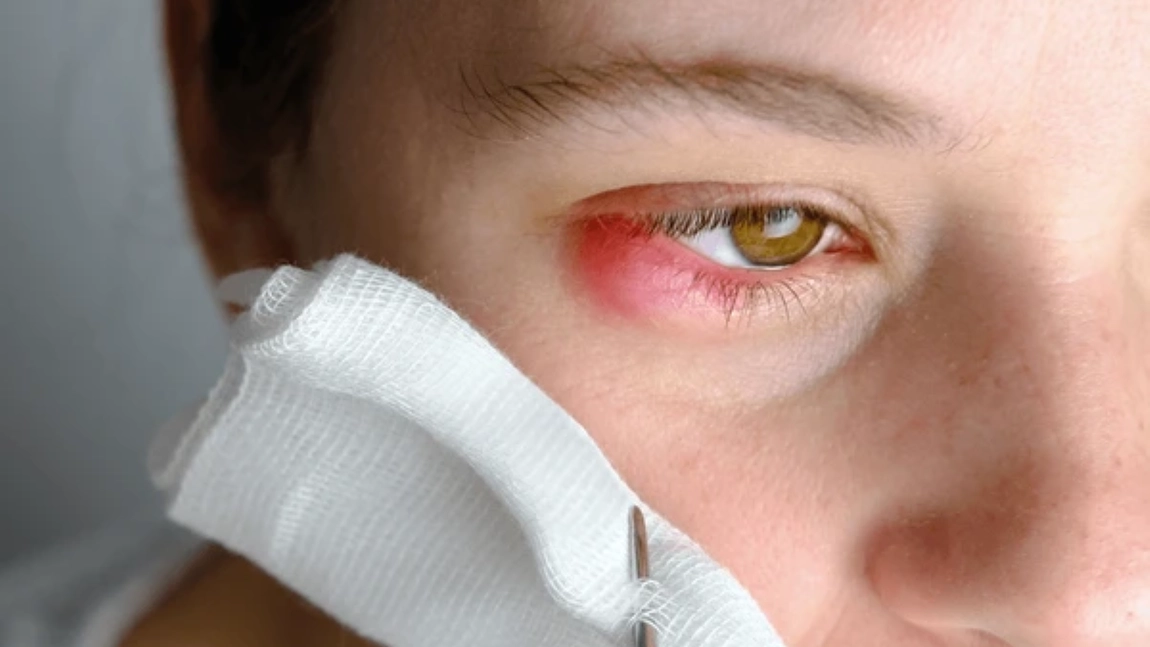 Herpesul ocular, o afecțiune care necesită atenție! Află dacă poate cauza pierderea vederii!