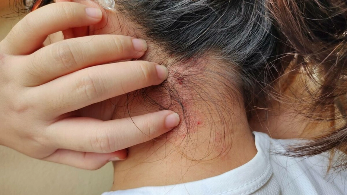 De unde ar fi luat lepră angajata unui SPA din Cluj. Se poate lua prin masaj?