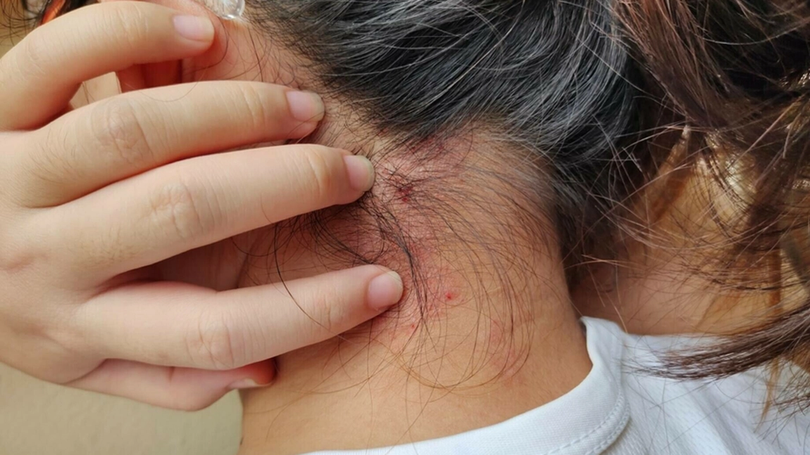 Croația confirmă un caz de lepră! Autoritățile anunță măsuri stricte pentru lucrătorii străini