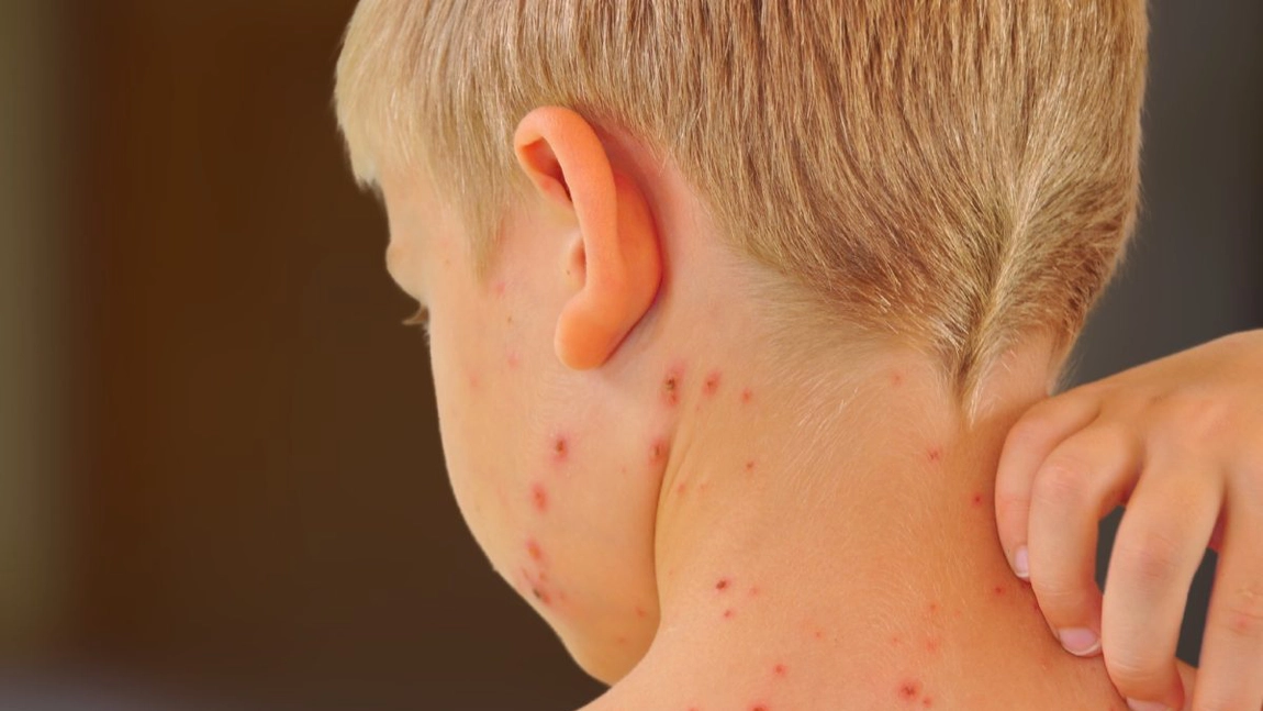 Noul simptom COVID la copii: erupții cutanate alarmante, semnalează medicii