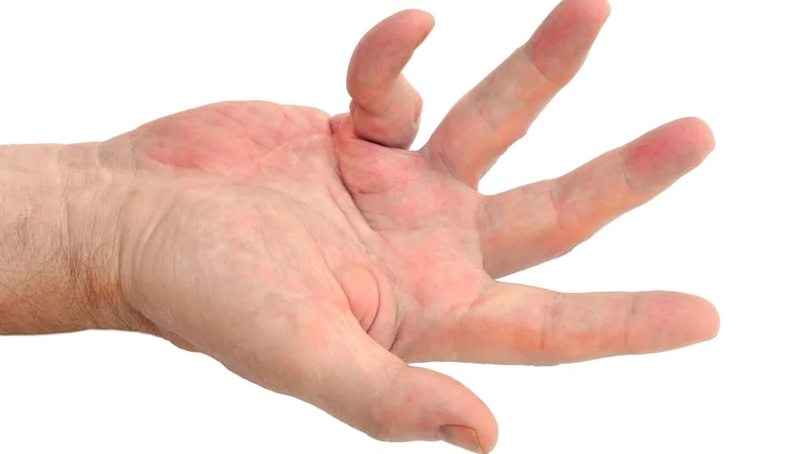 Exerciții pentru boala Dupuytren. Iată câteva sfaturi uitele despre cum poți îmbunătăți mobilitatea degetelor!