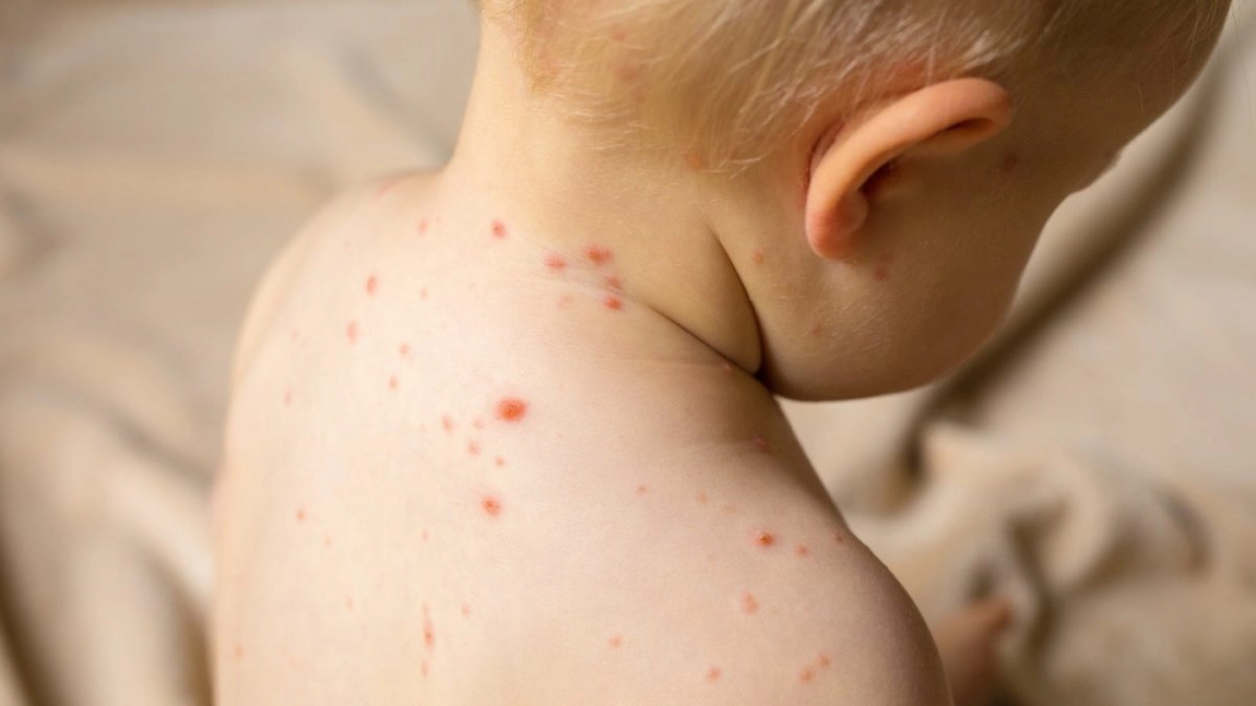 Cum recunoști un vărsat de vânt la copii? Iată ce trebuie să cunosacă părinții despre această afecțiune!