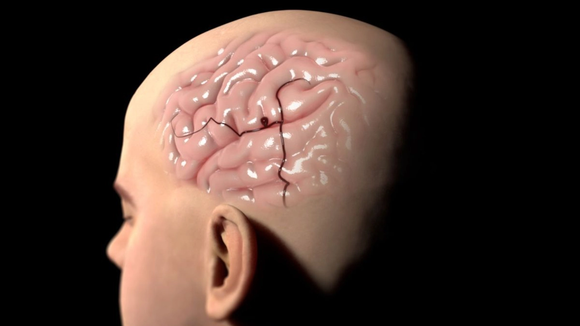 Ce poate declanșa un anevrism cerebral? Ruperea acestuia poate să fie fatală!