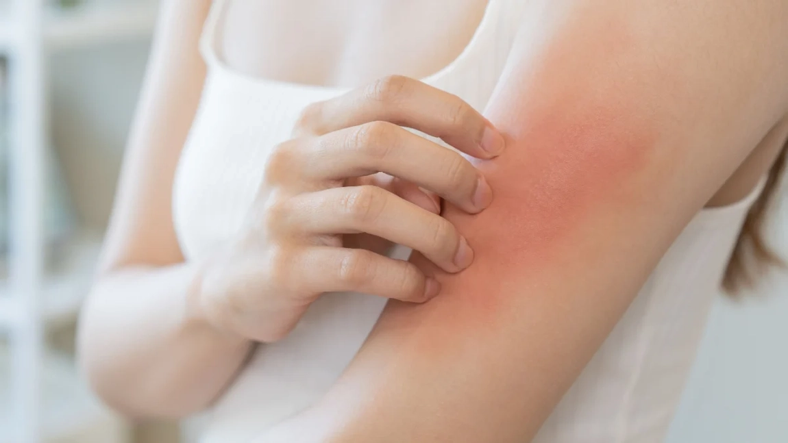 Este bun bicarbonatul de sodiu pentru mâncărimile de piele? Dr. Laura Mocanu explică care sunt cauzele și cum se pot ameliora natural!