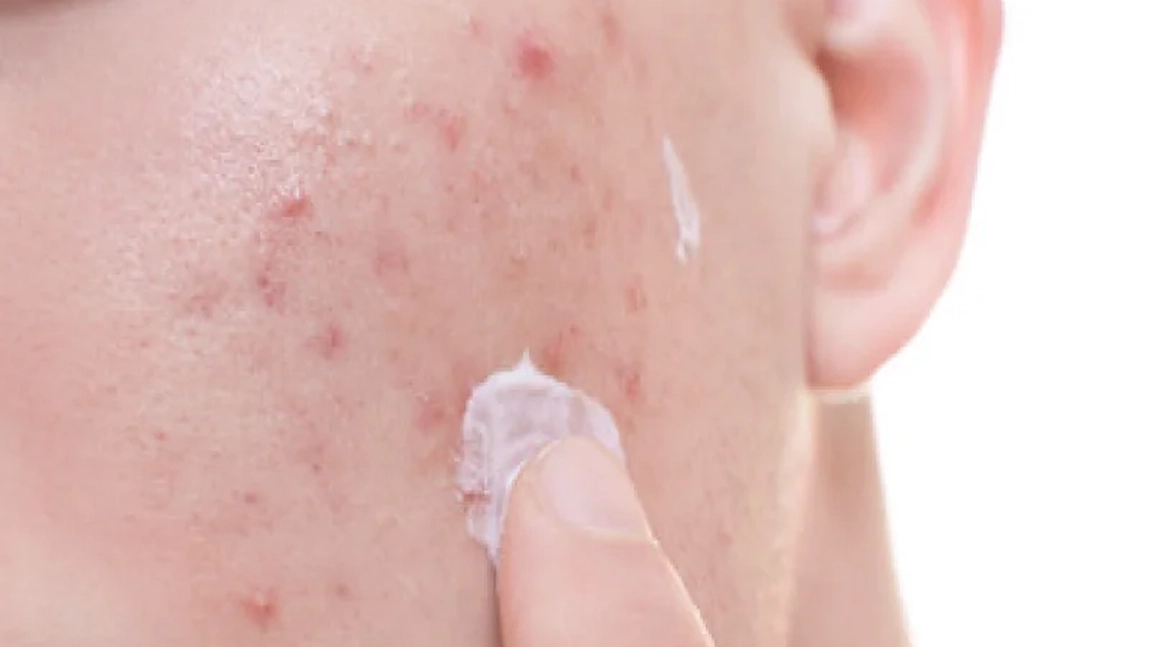 Se folosește crema hidratantă dacă ai ten acneic? Iată tot ce trebuie să știi!