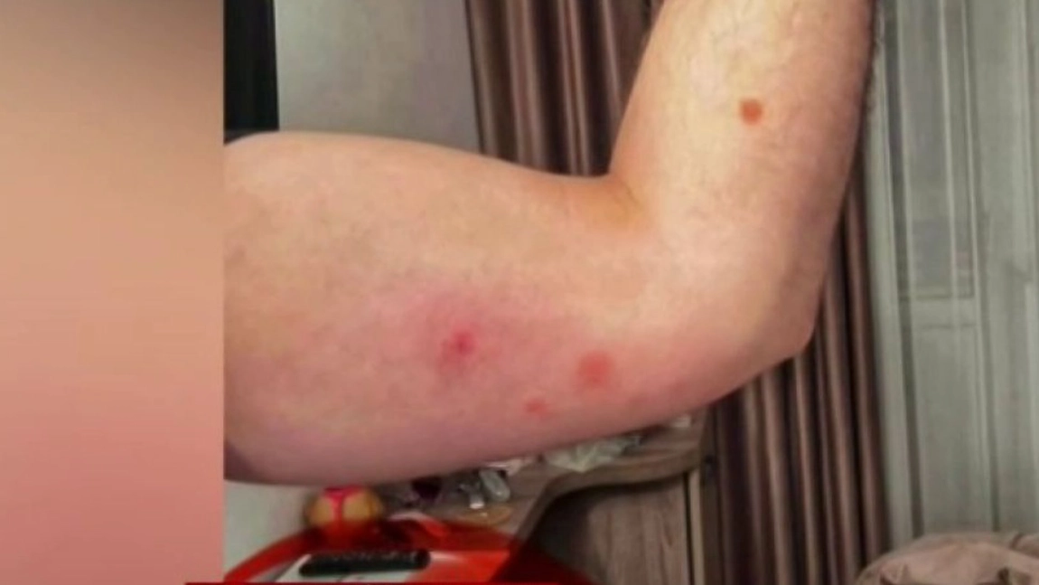 Vacanță de coșmar în Predeal! Un turist a fost mușcat de ploșnițe și a ajuns de urgență la spital