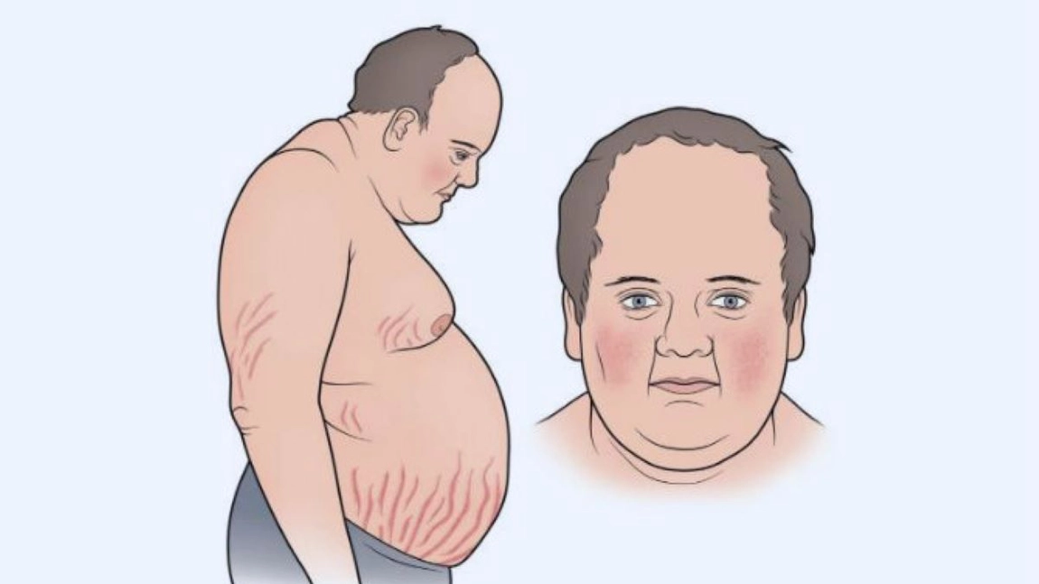 Cum se manifestă boala Cushing? Iată ce riscuri există pentru organism!