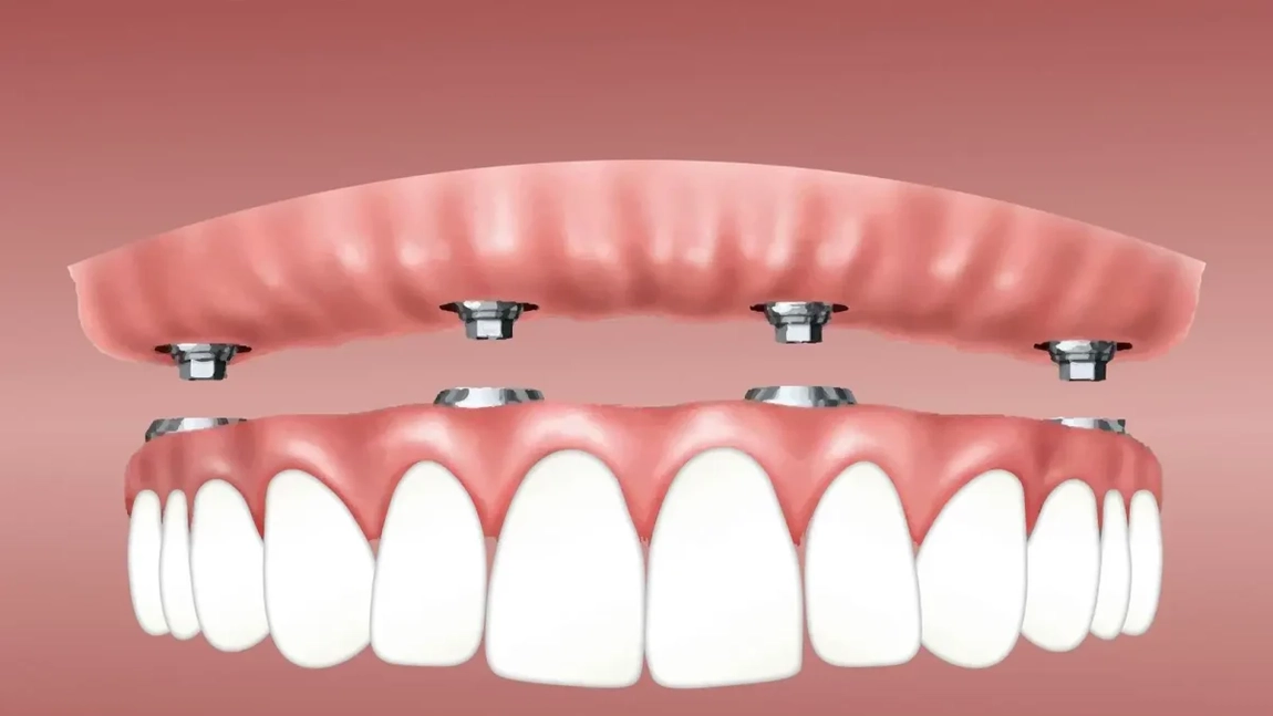 Cât costă un implant dentar pentru toată gura? Dr. Alexandru Ciucu explică tot ce trebuie să știi despre proces și prețuri!