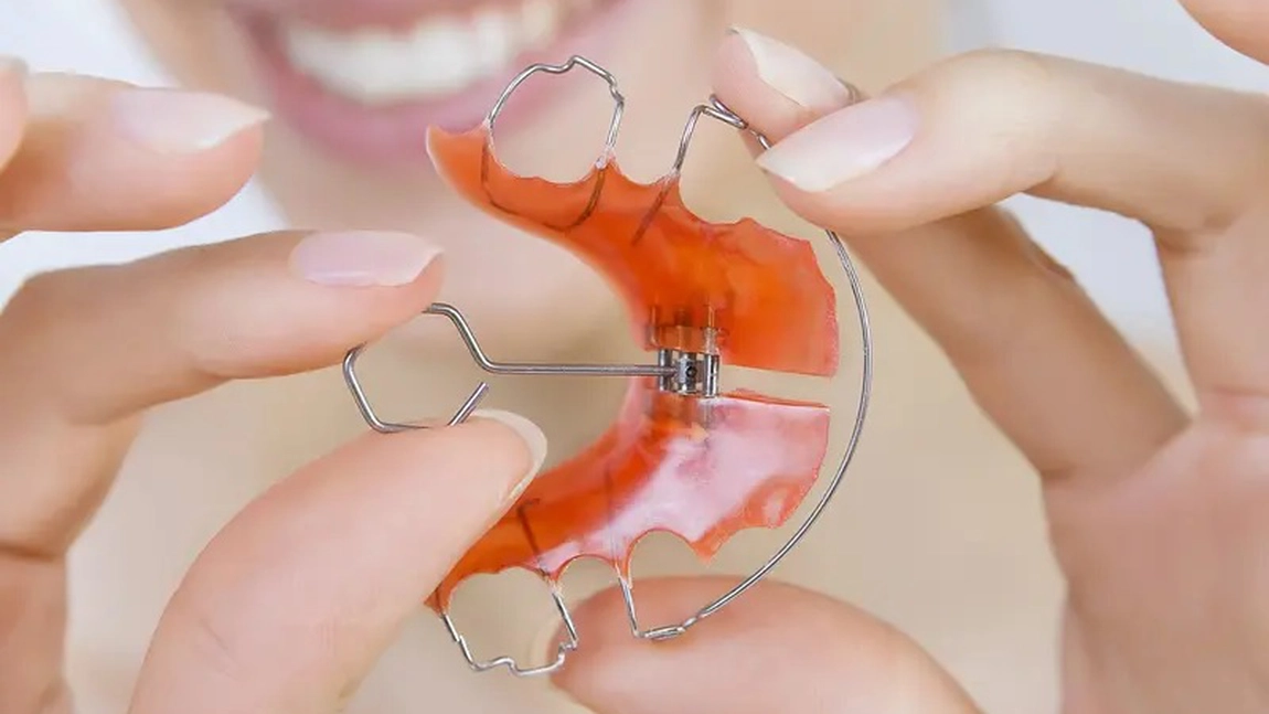 Ce este un disjunctor ortodontic? Iată când este recomandat un astfel de aparat!