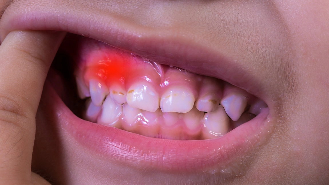 Gingivita la copii de 2 ani, tratament miraculos. Iată care sunt cauzele care duc la apariția afecțiunii, dar și ce recomandări fac specialiștii!