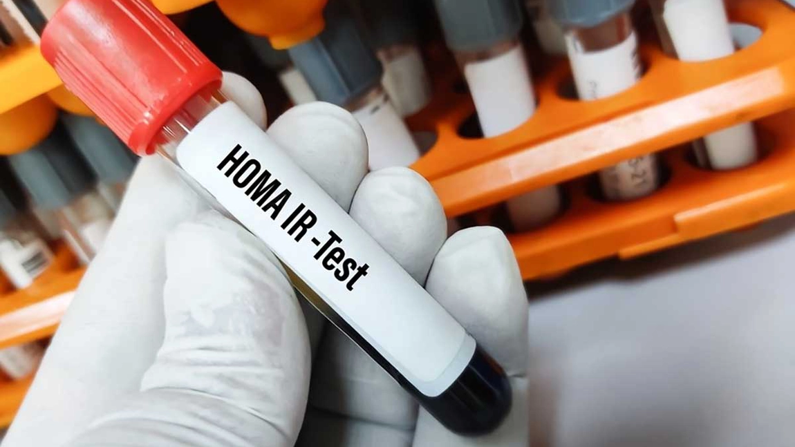 Ce trebuie să faci în cazul unui indice HOMA crescut? Iată când este recomandată testarea!