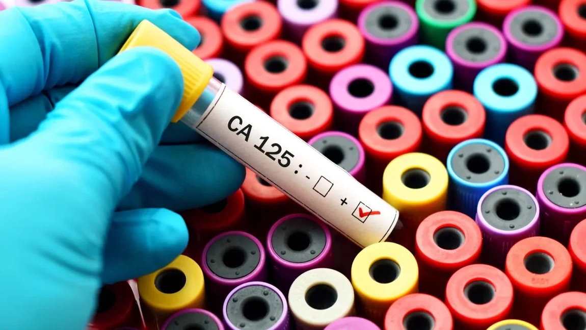 Care sunt markerii tumorali utilizați în diagnosticul și monitorizarea afecțiunilor la stomac? Dr. Cătălin Costovici explică tot ce trebuie să știi!