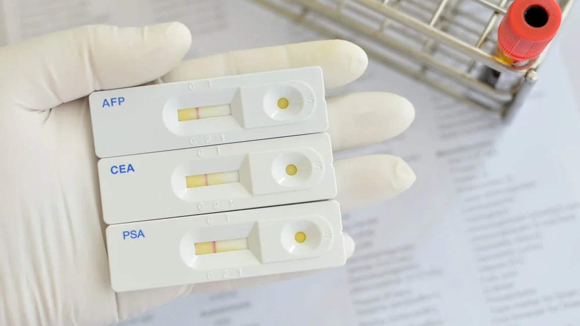 Cât de util este un pachet de analize de markeri tumorali? Dr. Cătălin Costovici explică când trebuie făcute investigațiile!